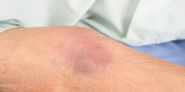 Hématome sous-dural chez les personnes âgées : compréhension et enjeux